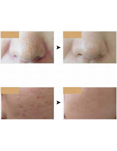 Mascara Terapia Con Luz Led Multiefecto