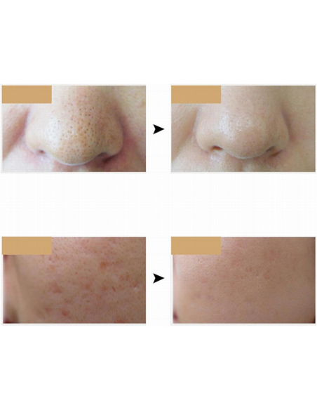Mascara Terapia Con Luz Led Multiefecto